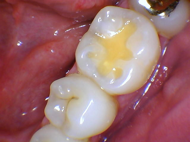 MouthWatch_IntraoralCamera_ImageQuality1 mouthwatch intraoral camera photo closeup