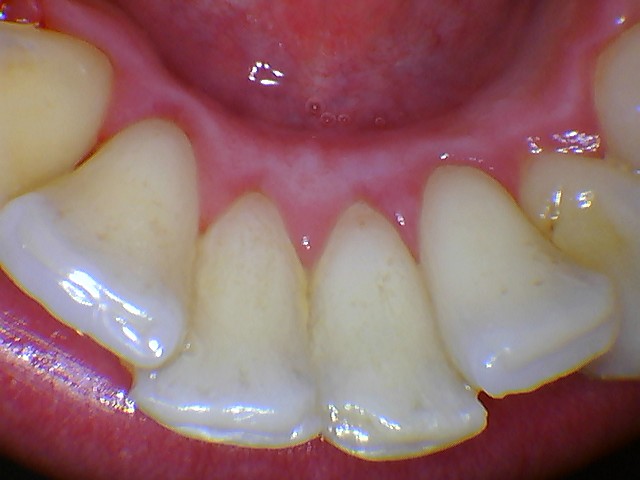 MouthWatch_IntraoralCamera_ImageQuality2 mouthwatch intraoral camera photo closeup