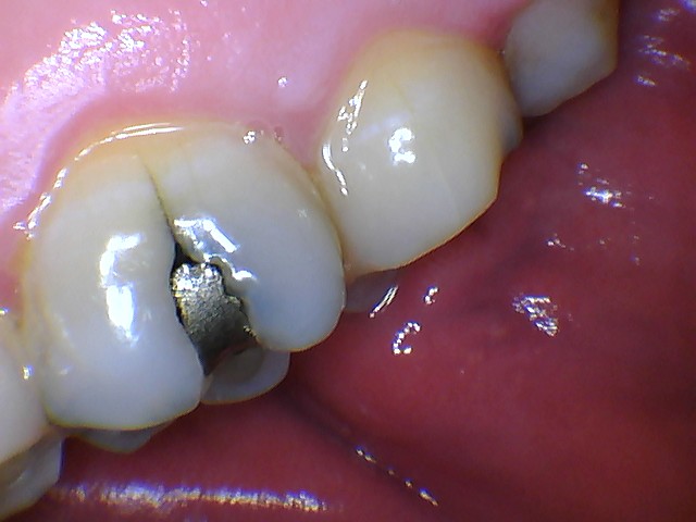 MouthWatch_IntraoralCamera_ImageQuality3 mouthwatch intraoral camera photo closeup